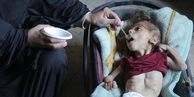 Kantor media Gaza: Lebih dari 65.000 anak di Gaza dirawat di rumah sakit karena kekurangan gizi parah