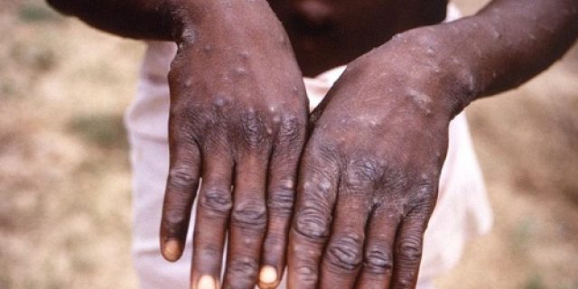 Apa Itu Virus Cacar Monyet Mpox?